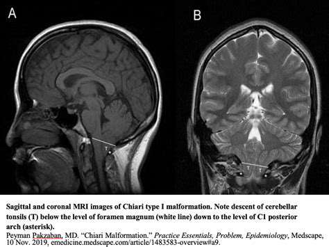 LivingwithChiariMalformationType1:AHolisticApproach